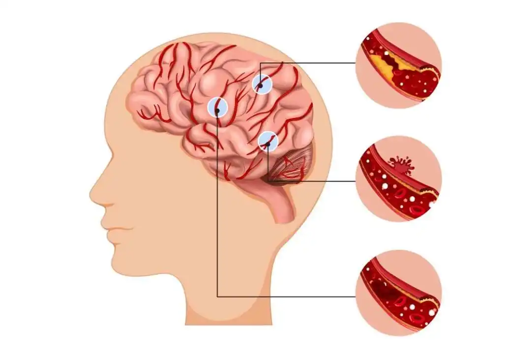 Keterlambatan Penanganan Pasien Stroke di Indonesia Keterlambatan Penanganan Pasien Stroke di Indonesia
